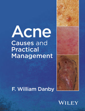 Acne: Causes and Practical Management 2015
