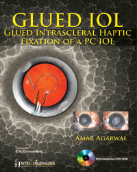 Glued IOL: Glued Intrascleral Haptic Fixation of a PC IOL