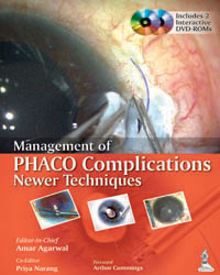 Management of Phaco Complications Newer Techniques