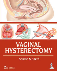 Vaginal Hysterectomy, 2e