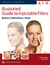 Illustrated Guide to Injectable Fillers: Basics, Indications, Uses 2016