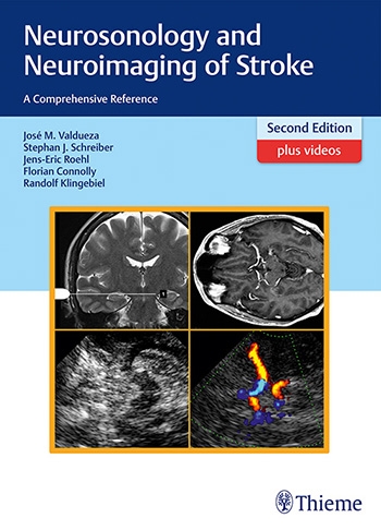 Neurosonology and Neuroimaging of Stroke 2/E 2017