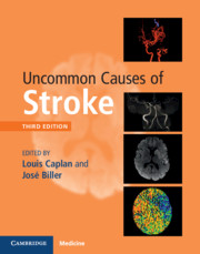 Uncommon Causes of Stroke 3rd Edition 2018