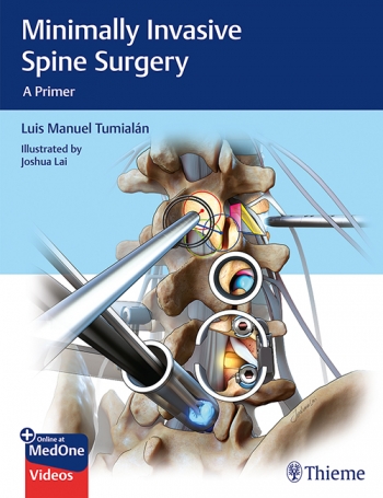 Minimally Invasive Spine Surgery: A Primer 2020