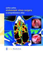 Endoscopic Sinus Surgery