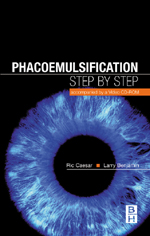 Phacoemulsification: Step by StepAccompanied by a Video CD Rom