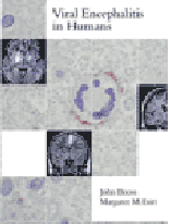 Viral Encephalitis in Humans