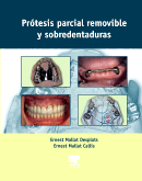 Protesis Parcial Removible y Sobredentadura