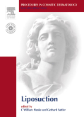 Procedures in Cosmetic Dermatology Se0ries: Liposuction - Textbook with DVD(已缺書)