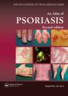 An Atlas of Psoriasis   2nd Edition