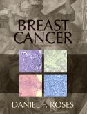 Breast Cancer, 2nd Edition