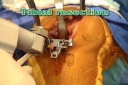 Minimally Invasive Total Knee Arthroplasty: The Mini-Midvastus Approach (DVD-video)