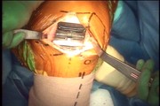 Minimally Invasive Total Knee Arthroplasty with a Subvastus Technique (DVD-video