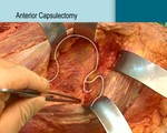 Surgical Technique for Triple Arthrodesis (DVD-video)