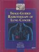 Image-Guided Radiotherapy of Lung Cancer