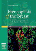 Preneoplasia of the Breast - A New Conceptual Approach to Proliferative Breast Disease