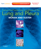 Tumors and Tumor-like Conditions of the Lung and Pleura - Expert Consult: Online and Print
