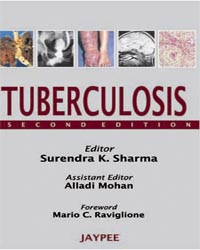Tuberculosis  2/E 2009