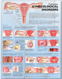 Common Gynecological Disorders Anatomical Chart Paper Unmounted