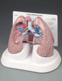 Diseased Lung Model