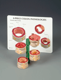 Four Piece Colon Model with Pathologies