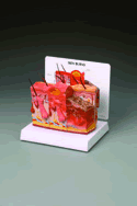 Skin with Burns Model