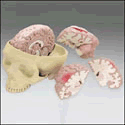 Diseased Brain in Skull