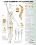 Understanding Osteoporosis Anatomical Chart Laminated
