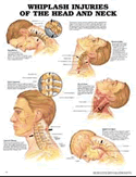 Whiplash Injuries of the Head and Neck Anatomical Chart Laminated