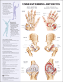 Understanding Arthritis Anatomical Chart Laminated