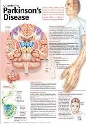 Understanding Parkinson's Disease Anatomical Chart Laminated