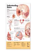 Understanding Stroke Anatomical Chart Laminated