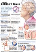 Understanding Alzheimer's Disease Anatomical Chart Laminated