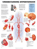 Understanding Hypertension Anatomical Chart Laminated