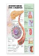 Understanding Type 2 Diabetes Anatomical Chart Laminated