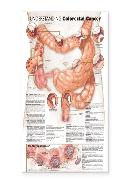 Understanding Colorectal Cancer Anatomical Chart Laminated