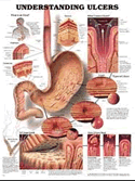 Understanding Ulcers Anatomical Chart Laminated