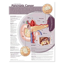 Understanding Pancreatic Cancer Anatomical Chart Laminated