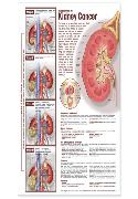 Understanding Kidney Cancer Anatomical Chart Laminated