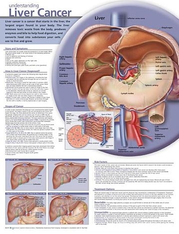 Understanding Liver Cancer Anatomical Chart Laminated