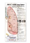 Understanding Lung Cancer Anatomical Chart Laminated