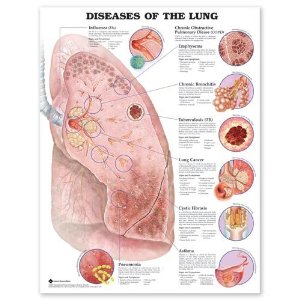 Diseases of the Lung Anatomical Chart Laminated