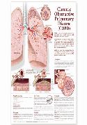 Chronic Obstructive Pulmonary Disease Anatomical Chart Laminated