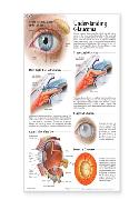 Understanding Glaucoma Anatomical Chart Laminated