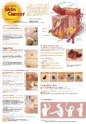 Understanding Skin Cancer Anatomical Chart Laminated