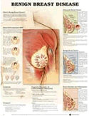 Benign Breast Disease Anatomical Chart Laminated