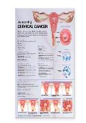 Understanding Cervical Cancer Anatomical Chart Laminated