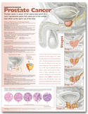 Understanding Prostate Cancer Anatomical Chart Laminated