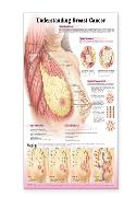 Understanding Breast Cancer Laminated