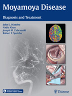 Moyamoya Disease Diagnosis and Treatment